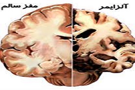 بیماری آلزایمر و  مواد موثر بر بهبود عملکرد مغز