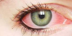 بیماری عفونی چشم آوا هلث