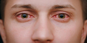 بیماری های عفونی چشم و روش های جلوگیری از آن آوا هلث